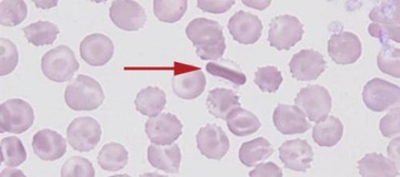 Hemoglobin C Semptomları