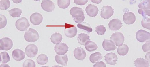 Hemoglobin C