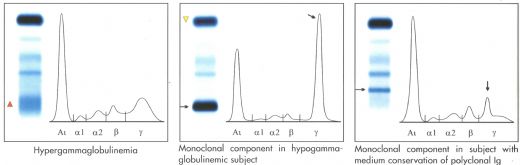 Hemoglobin Elektroforezi